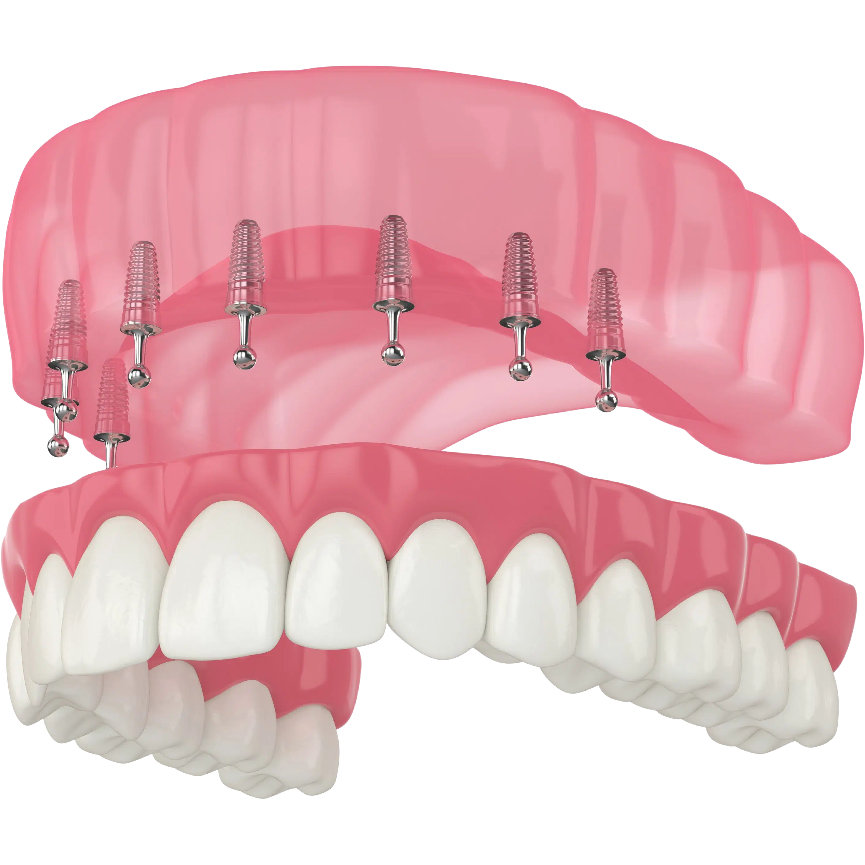 snap-on-dentures